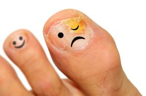 How To Get Rid Of Toenail Fungus