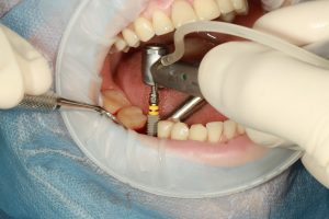 Top 4 Dental Conditions That Qualify for Dental Implants