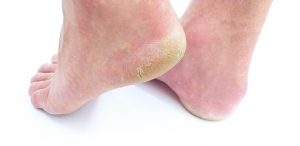 Remedies for Heel Pain